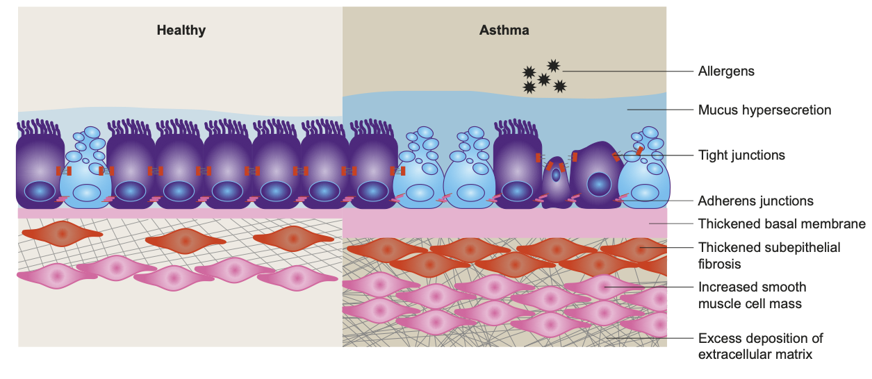 Figure 1: The airway epithelium is altered in asthma