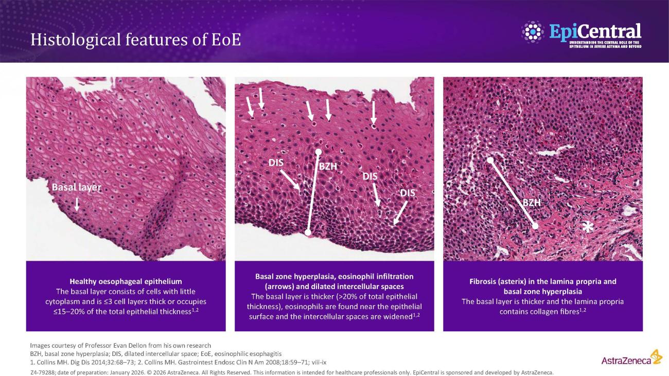 Histological features of EoE. Three frames showing histological features in a healthy oesophageal epithelium, basal zone hyperplasia with eosinophil infiltration and dilated intercellular spaces, and fibrosis in the lamina propria.